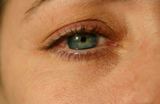 why-are-my-eyes-itchy-find-natural-solutions